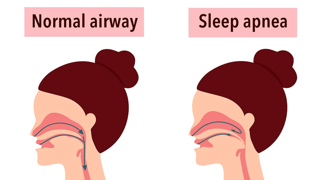 Sleep Apnea Diagram